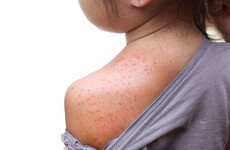 Three suspected and one confirmed case of measles reported in latest weekly figures