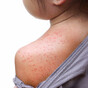 Three suspected and one confirmed case of measles reported in latest weekly figures