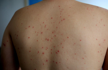 One case of measles confirmed in Northern Ireland, linked to rise of cases  across Europe