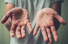 11 possible cases of measles in Ireland last week, according to latest report