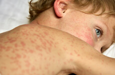 Two more measles cases confirmed - bringing total number this year to 11