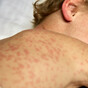 Two more measles cases confirmed - bringing total number this year to 11
