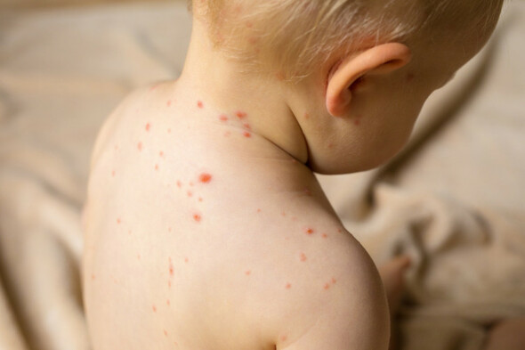 Two more measles cases confirmed - bringing total number this year to 18 - Vimarsana News