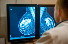 HSE approves new drug that can cut the chances of breast cancer recurring by over 30%