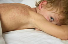 Measles: 56 cases confirmed in Ireland so far this year