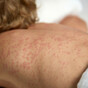 Sixty-eight measles cases confirmed in Ireland so far this year