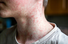 Measles: 81 cases and 13 outbreaks confirmed in Ireland so far this year