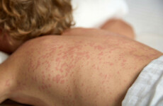 HSE issues measles warning to passengers on board bus from Dublin Airport and flight from Naples