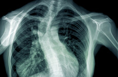 Boy with life-threatening scoliosis removed from surgery wait list without family being informed