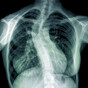 Boy with life-threatening scoliosis removed from surgery wait list without family being informed
