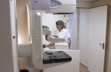 Breast cancer screening "reduces deaths, but over-diagnoses"
