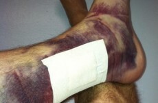 Player shows just how much damage a baseball can do to the human body