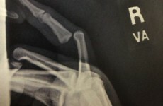 NFL player tweets X-ray of his broken finger 'to prove he didn't commit a penalty
