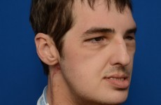 Pictures: Results of most extensive face transplant ever