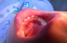 Teeth pulled for stem cell harvest