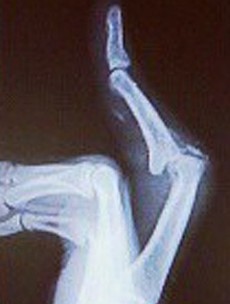 NFL player tweets X-ray of what his mangled finger looked like during the playoffs