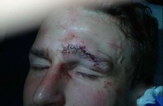 That looks painful: Robert Huth needed 28 stitches after a nasty collision with Franco Di Santo