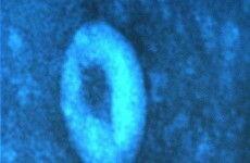 UK patient dies from SARS-like coronavirus