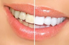 Dentists' body expresses concern over illegal teeth whitening