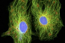 Gene test may save prostate cancer patients from needless surgery