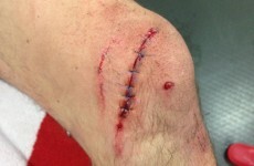Austrian player's knee comes off second best after James McCarthy's crunching tackle