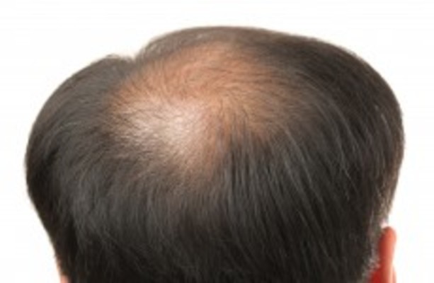 Study uncovers link between male baldness and heart disease