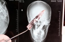 10cm blade removed from man's head after four years