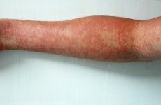 HSE has this warning for families as 800 people in the UK hit by measles