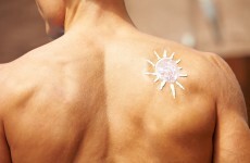 Melanoma Awareness Month: 100 people die of melanoma every year in Ireland