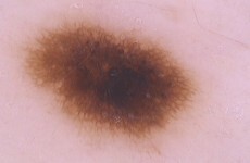 Calls for health insurers to include mole mapping in general policies