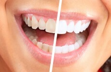 Fancy getting your teeth whitened? You need to know this
