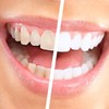 Fancy getting your teeth whitened? You need to know this