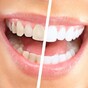 Fancy getting your teeth whitened? You need to know this