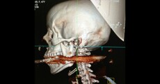 Woman shot in the mouth by harpoon - and survives