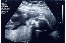 Demand for public IVF treatment doubled in recession
