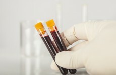 The median age for new HIV cases in Ireland? 33