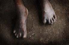 Ireland records first known case of leprosy in decades