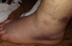 This is what a Lions tour-ending injury looks like