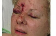 Gruesome picture shows aftermath of fan struck in face by a puck at Stanley Cup finals