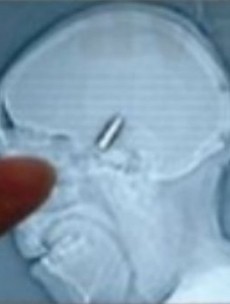 No biggie: Serbian goalkeeper plays on with a bullet in his head