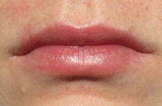 Woman accidentally superglues lips together