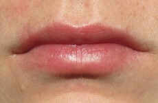 Woman accidentally superglues lips together