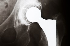 HSE to order review of all metal-on-metal hip replacement devices