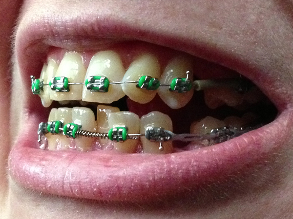 0214-braces