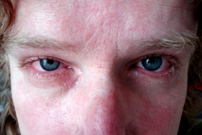 hooikoorts / hayfever