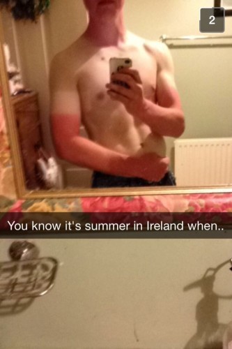 The problem with being Irish in the summer... - Imgur