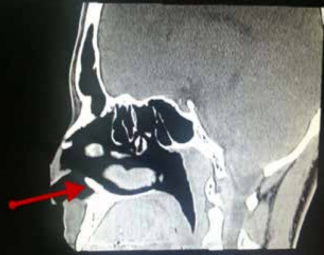 nosetoothxray