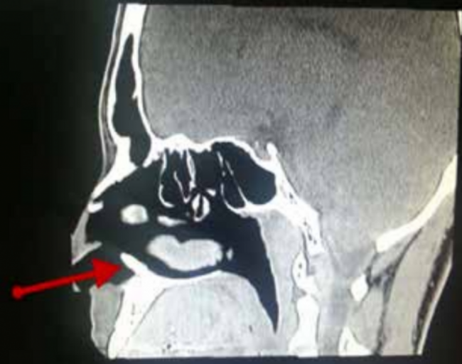 nosetoothxray