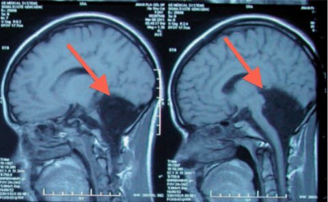 cerebellum-mri-scan