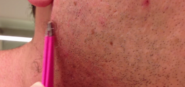 This Guy S Incredibly Long Ingrowing Hair Will Gross You Out Like